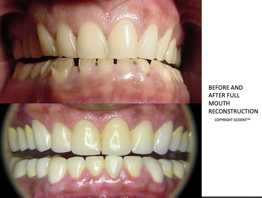 FULL MOUTH REHABILITATION OF A 45 YEAR MALE WITH DEEP BITE AND HABIT OF TEETH CLENCHING AND GRINDING