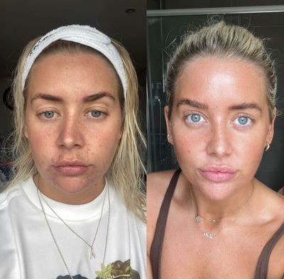 Before and after skincare transformation of a woman.