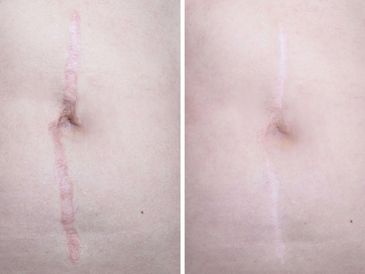 Vertical abdomen scar darker and wider before and thinner and lighter after.