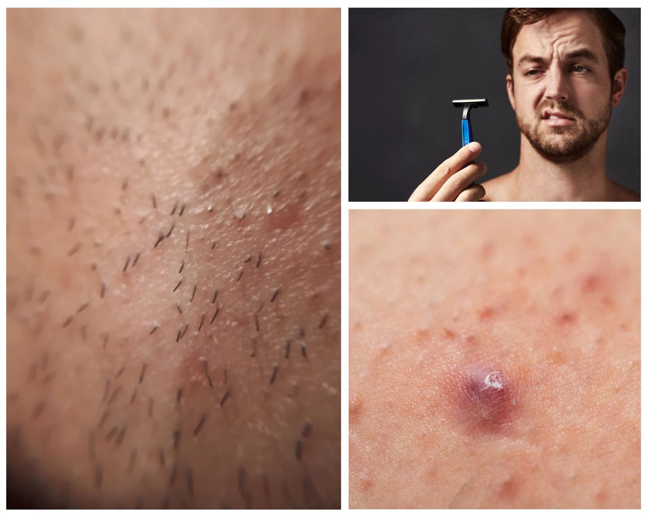 Effective Strategies for Treating and Preventing Ingrown Hairs, image size:1280x1024