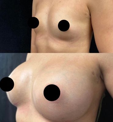 Before and after images of breast augmentation surgery.