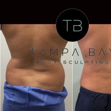 Before and after body sculpting results showing reduced back fat.
