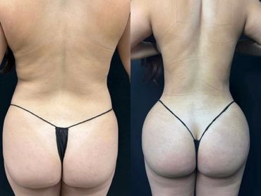Before and after body contouring showing enhanced buttock shape.