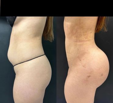 Before and after body contouring showing a slimmer waist and brazillian butt lift BBL enhancement