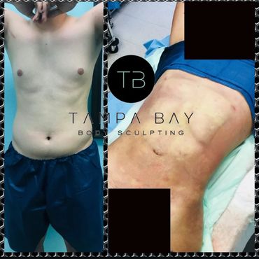 Before and after body sculpting treatment showing abdominal changes.