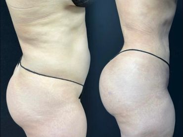 Side-by-side comparison of a person's lower body before and after a cosmetic procedure.