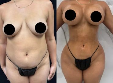 Before and after photo of a woman's body transformation showing enhanced curves and toned abdomen.