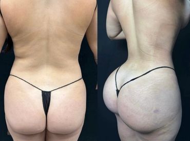 Before and after photo of a woman showing body contouring results.