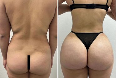 Before and after photos showing brazillian butt lift BBL transformation.