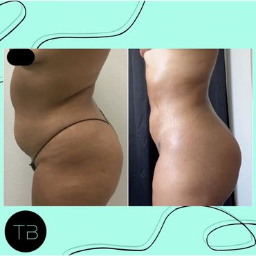 Side-by-side before and after photos showing body contouring results.  Lipo360, waist contouring