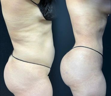 Side-by-side before and after photos showing body contouring results on a woman.
