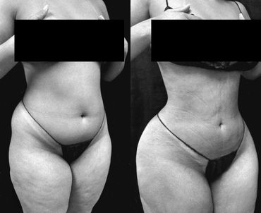 Before and after body contouring showing reduced abdominal and thigh size.