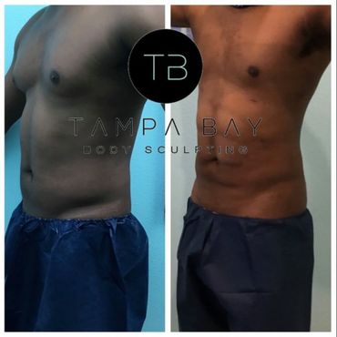 Before and after body sculpting showing a toned abdomen transformation.