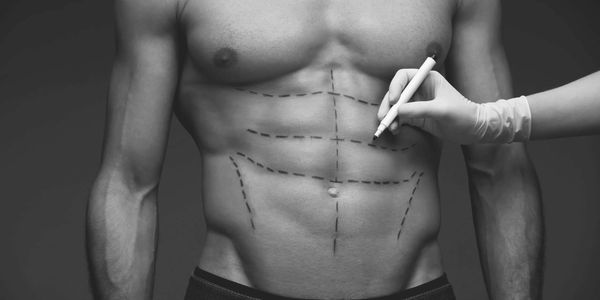 Marking a man's torso with surgical lines for cosmetic contouring.