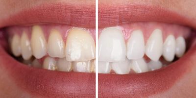 Teeth whitening near me