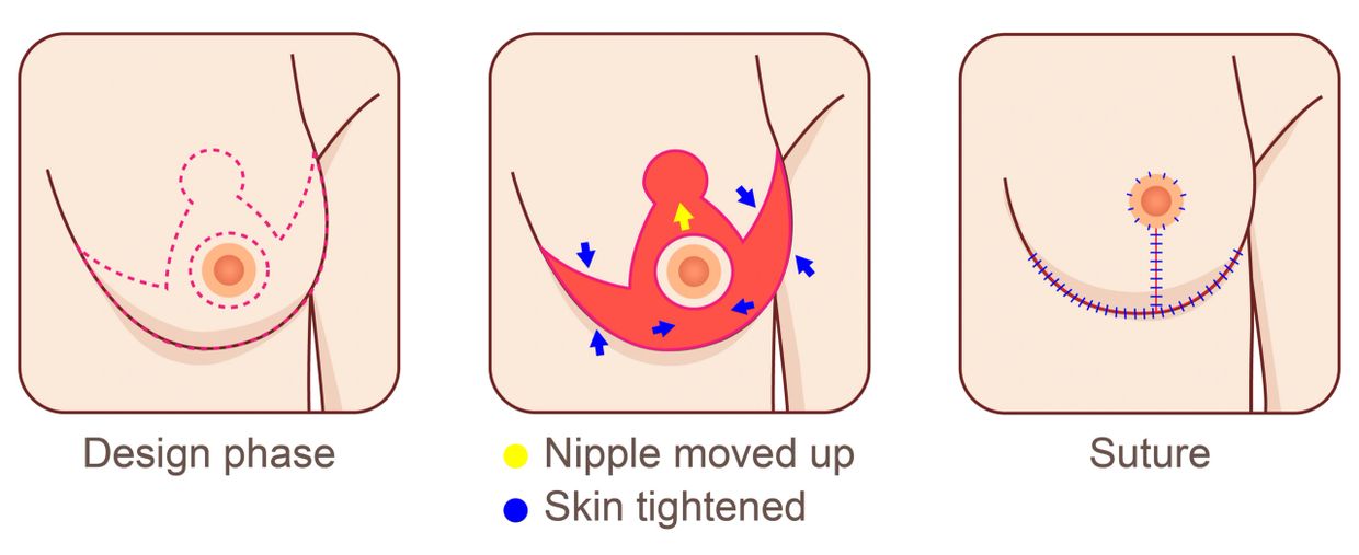 mammoplasty reduction surgery