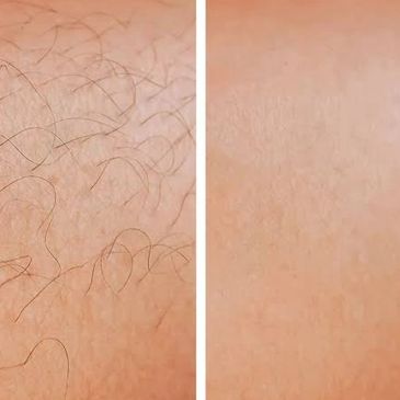 Laser hair removal is a medical procedure that uses laser, to reduce unwanted hair.