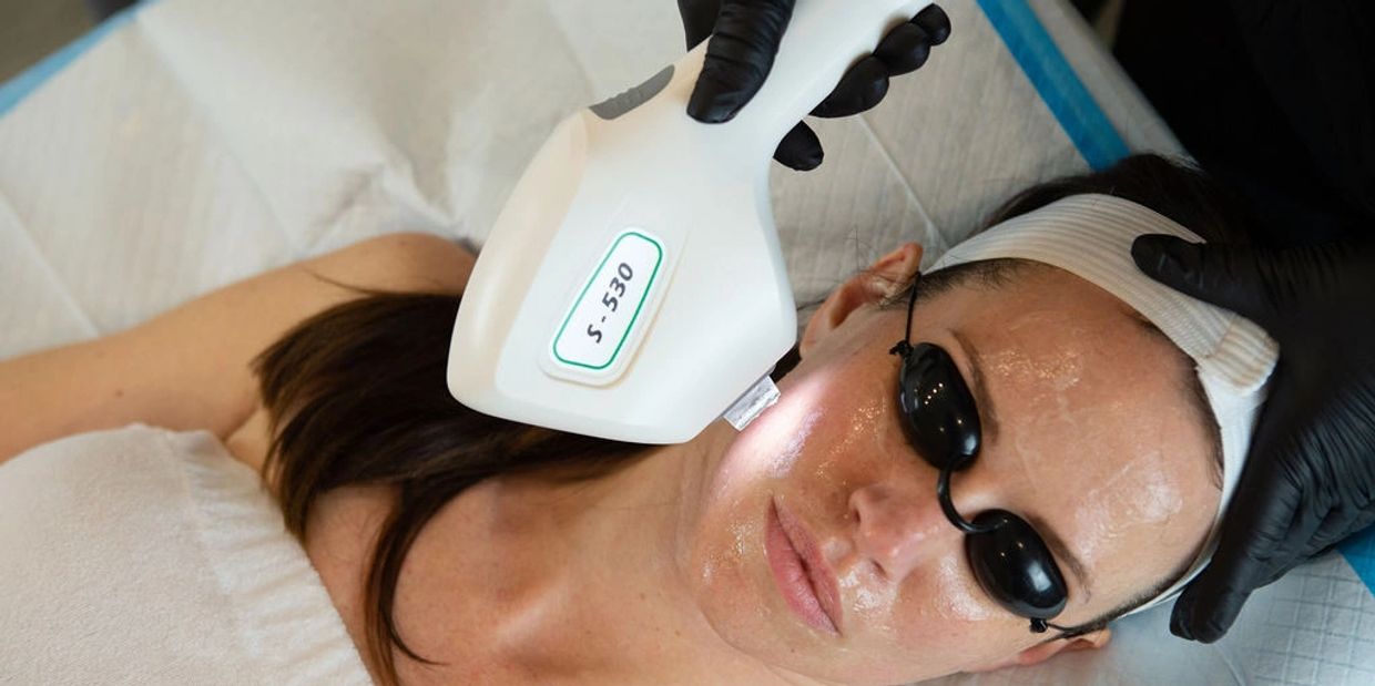 IPL treatment for a woman with long hair and goggles on her eyes lying on a bed