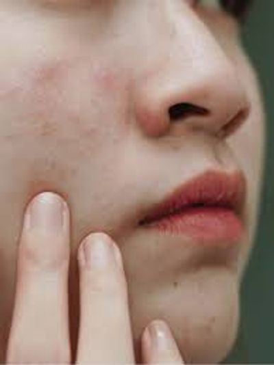 Dry skin concern image from a close up of a woman with her two fingers on her face with acne