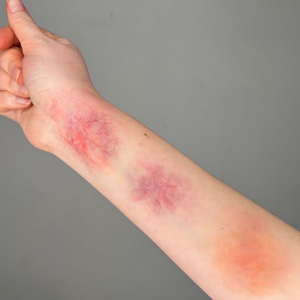 Bruise Makeup