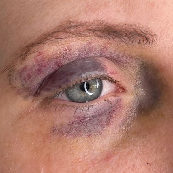 Black Eye / Bruising Makeup