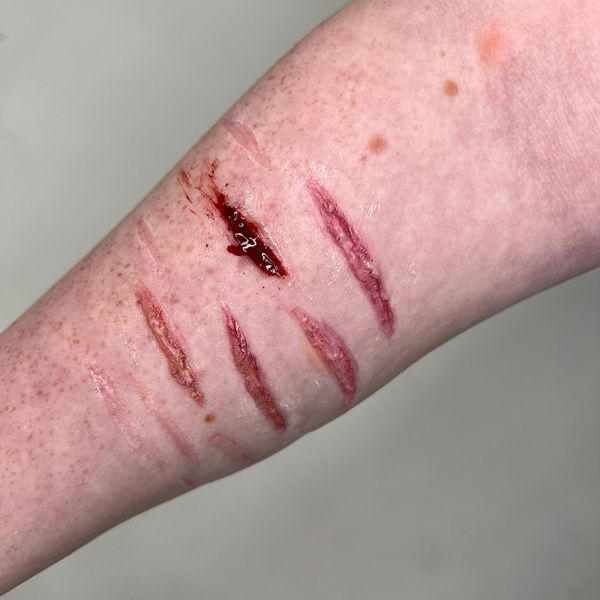 Keloid Scar Makeup