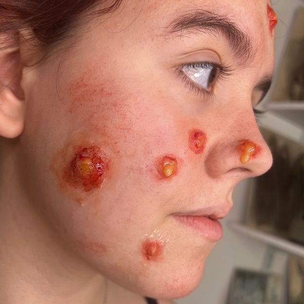 SFX Boil Makeup