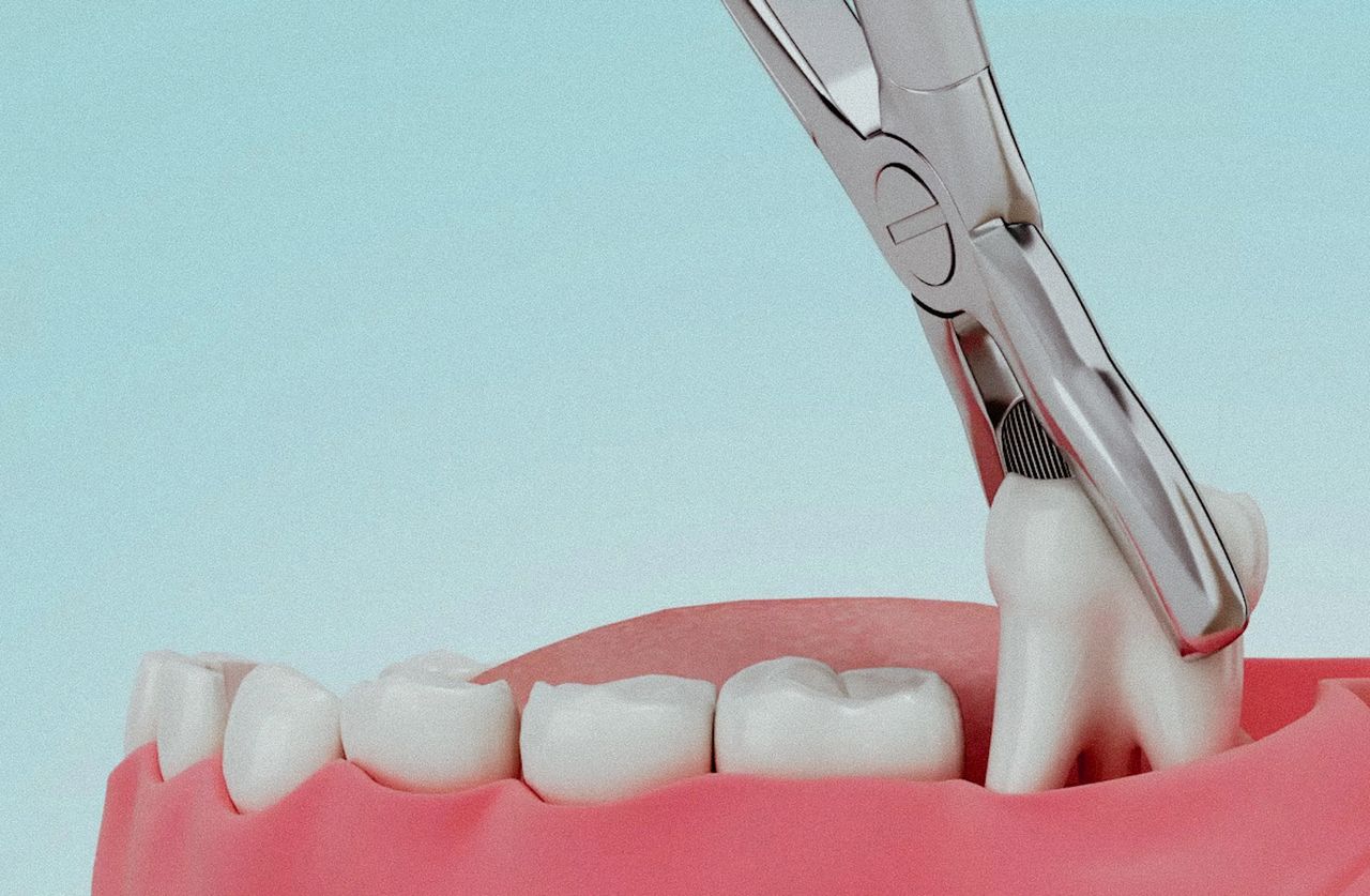 Extraction des dents de sagesse : quand et pourquoi la faire ?