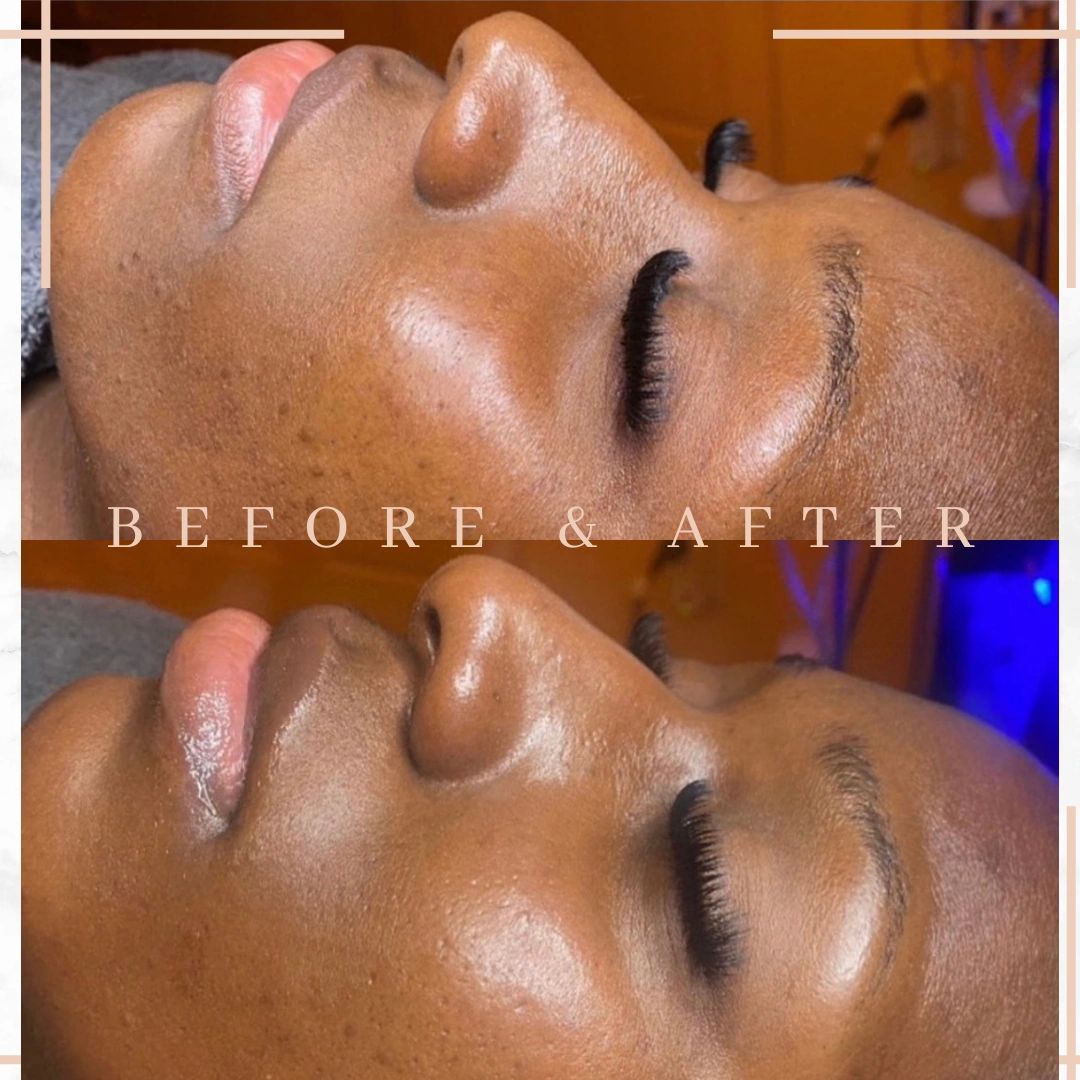 Hydrofacial Diamond Glow Facial