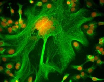 Human ovarian cancer cells stained for DNA (red) and microtubules (green). Therapeutic focus: Cancer