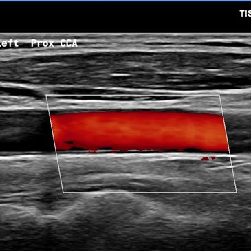 Carotid Doppler image