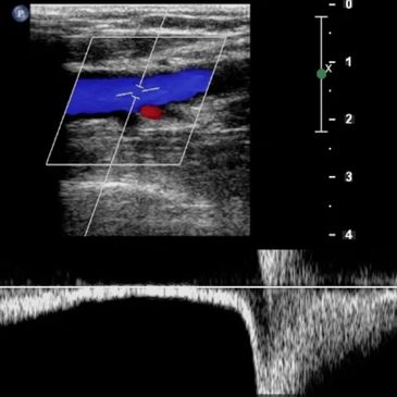 Vascular Doppler for DVT image