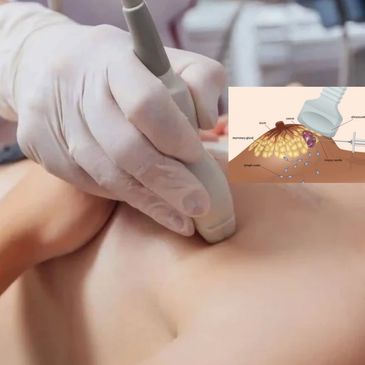 Breast Ultrasound 