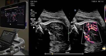 Ultrasound machine displaying a fetal ultrasound scan with color Doppler imaging.