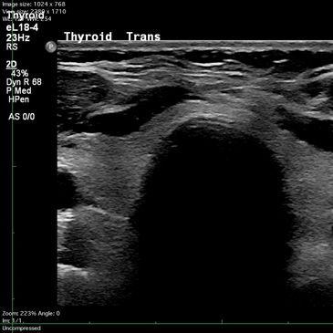 Thyroid ultrasound image