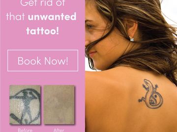 #tattooremoval #tattoo #inkregrets #tattooregrets #hatemytattoo #stamptramp #laserclinic #lasergta