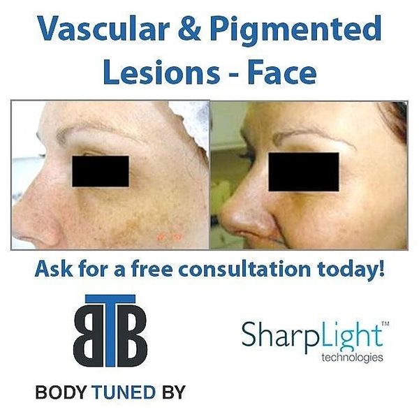 #pigmentationremoval #ipl #photofacial #fractionallaser #lasertreatments medicalspa bodytunedby skin