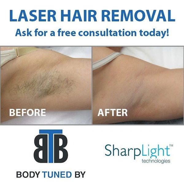 #laserhair #underarmhair #nohair #hairremoval #bodytunedby #laserclinic #nopainhairremoval #laser