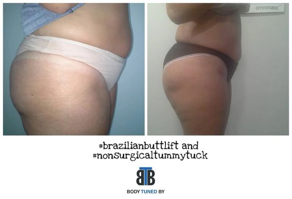 #brazilianbuttlift #nonsurgicalbuttlift #nonsurgicaltummytuck #tummytuck #liftedbum #fatmelting #btb