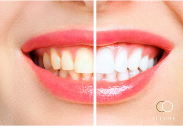 teeth whitening in Aruba 
