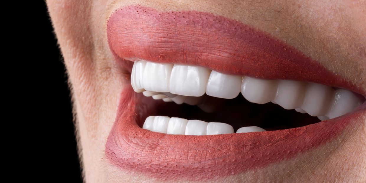 sorriso de mulher que fez tratamento com facetas de porcelana, lentes de contato dental