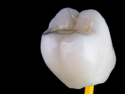 coroa dental de porcelana, tratamento de protese fixa sobre dente