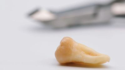 siso extraido, cirurgia de exodontia de siso, terceiro molar