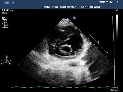 Neonatal Echo Training - Delhi Child Heart Center