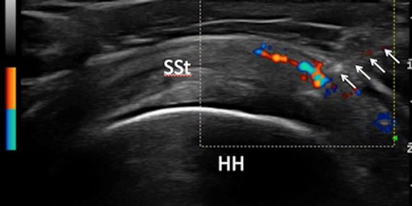 Color ultrasound for large joint injections.