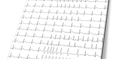 Eletrocardiograma esquemático