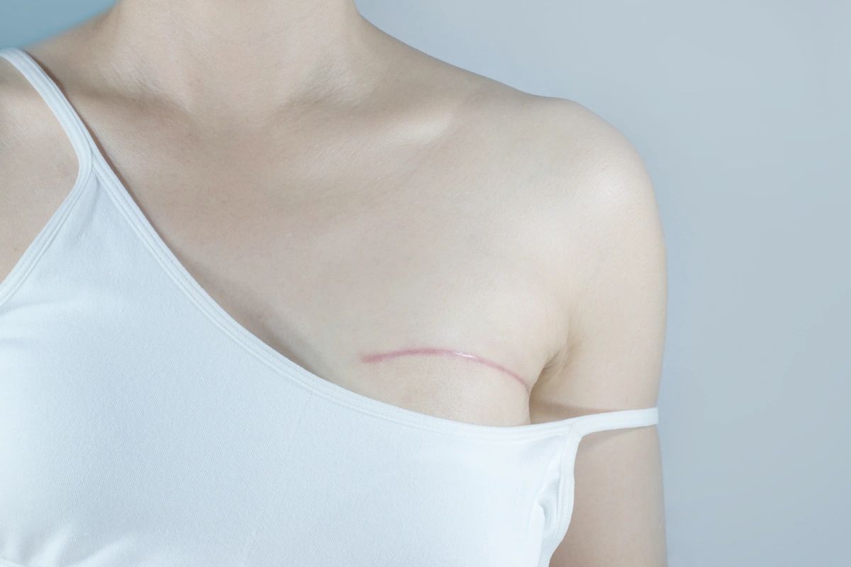 Scar camouflage tattoo for surgical scars Los Angeles