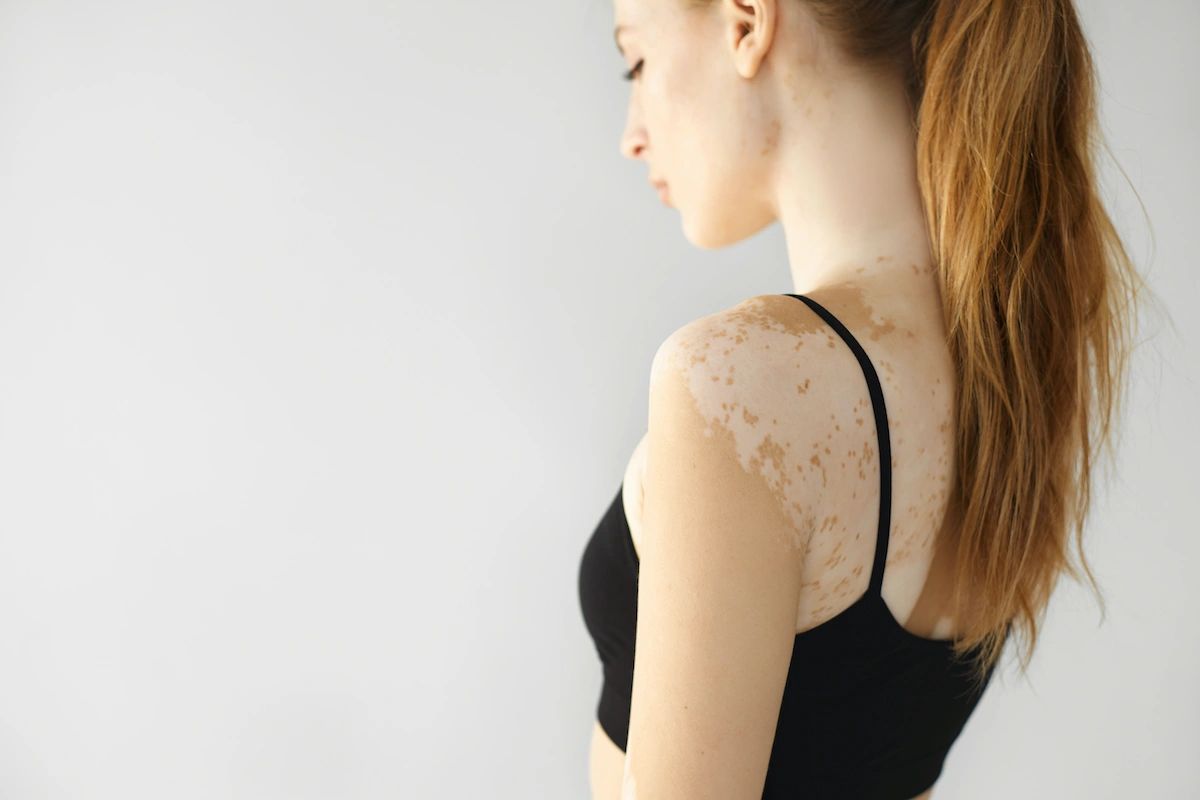 Vitiligo camouflage tattoo Los Angeles