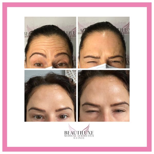 botox bamber bridge
botox preston
botox near me
botox chorley
nurse prescriber botox preston
