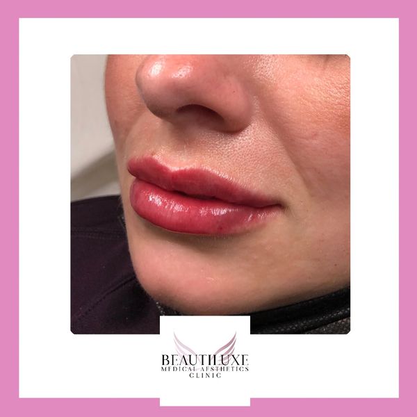 Lip fillers preston
lip fillers bamber bridge
lip fillers chorley
natural looking lip fillers
